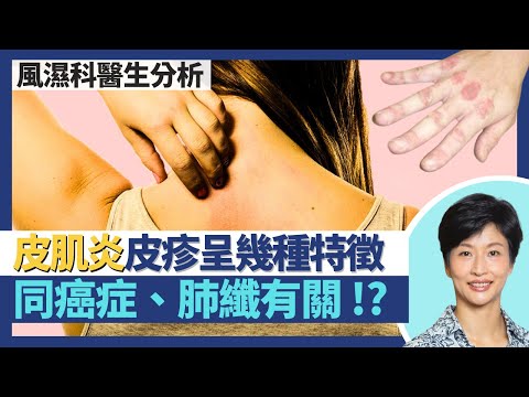 皮肌炎｜與癌症、間質性肺病肺纖維化有關？眼周圍／關節出疹、V形皮疹或是皮肌炎！自身免疫系統失調致皮膚肌肉發炎！｜王建芳醫生 風濕科醫生陳昭慧醫生 鍾浩然醫生｜人類健康研究所