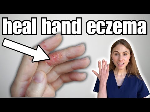 How To Heal Hand Eczema Fast