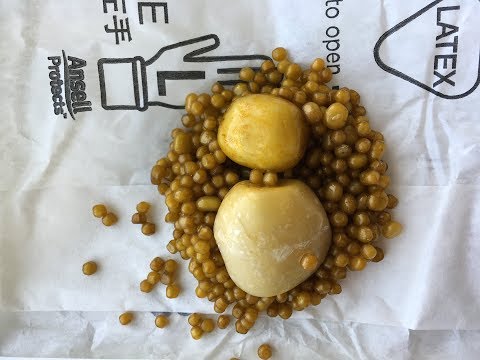 Dangerous size of gallstones