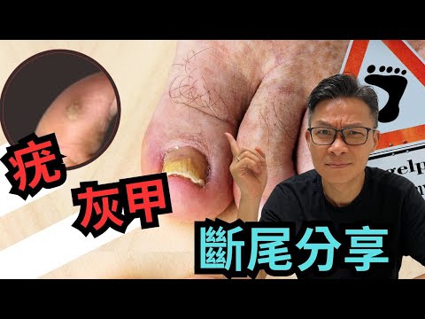 灰甲，病毒疣 有乜好怕。同你分享處理同戰鬥親身經驗。#灰甲 #疣 #真菌 #病毒 #香港腳