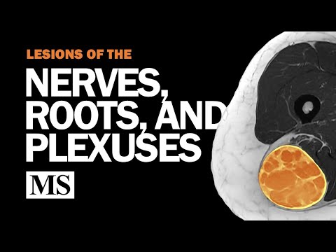 Localization of Peripheral Nervous System Lesions