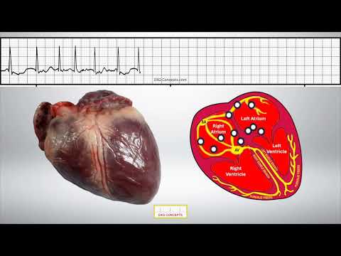 Atrial Fibrillation awareness!  Why it is so important!