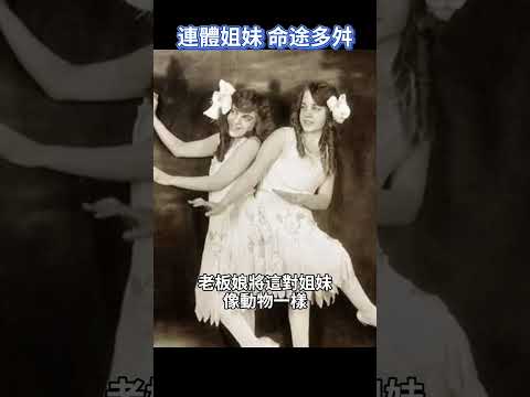 震驚！連體姐妹居然能各自嫁人？！姐姐死後，妹妹與遺體共存2天