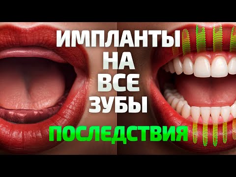 Импланты на все зубы. Что вас ждёт? Последствия о которых молчат!