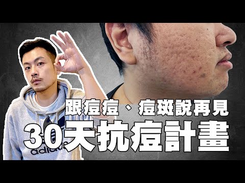 跟痘痘、痘斑說掰掰，30天快樂抗痘計畫，超級有效讓你膚質大提升~~~! 【77老大】