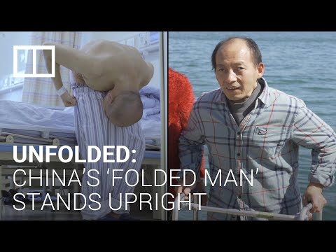 China’s ‘folded man’ finds happiness on road to recovery after complicated surgeries