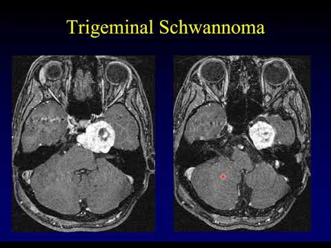 Temporal Bone Pathology 2:  Cerebellopontine Angle