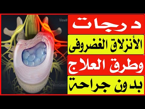 درجات الأنزلاق الغضروفى وطرق العلاج بدون جراحة/ا.د.محمد حمادة أستاذ علاج الألم بطب الازهر