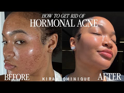 How to GET RID OF hormonal acne and HEAL your GUT | WHAT DOCTORS WON'T TELL YOU | KIRAH OMINIQUE