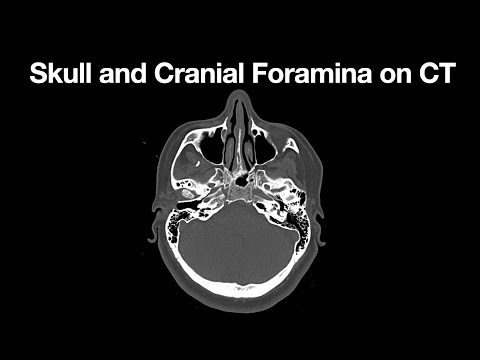 Anatomy of the Skull on CT