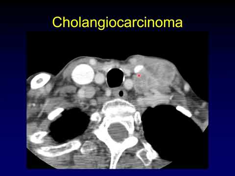 What's in Virchow's Node?