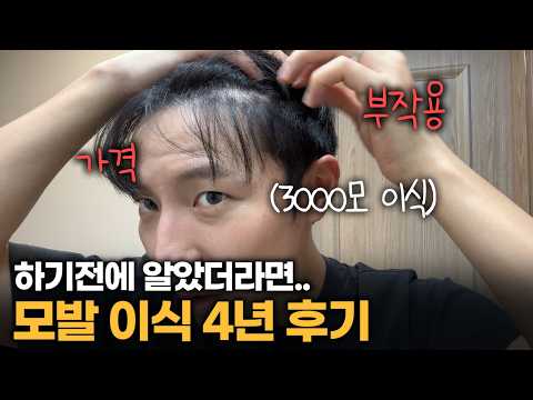 모발 이식 4년 후.. 후기, 부작용, 가격 싹 다 알려드립니다.