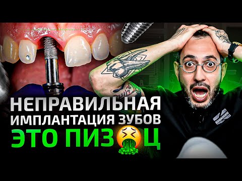 П*здец на имплантации — вот к чему приводит неправильная имплантация зубов