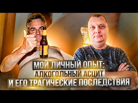 Alcoholic Ascites and Its Tragic Consequences - My Personal Experience