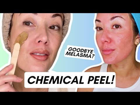 Cosmelan MD Chemical Peel: Does It Really Work for Melasma & Hyperpigmentation?