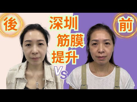 祖哥太太,親身上深圳做(筋膜提升)😱😱拍攝全過程👍手術前後對比👍提醒大家一定要睇尾段視頻❤️❤️
