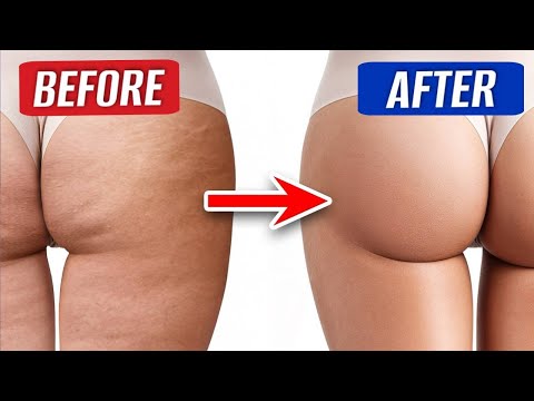 CELLULITE WILL BE GONE 🔥 How to eliminate cellulite WITHOUT SURGERY?