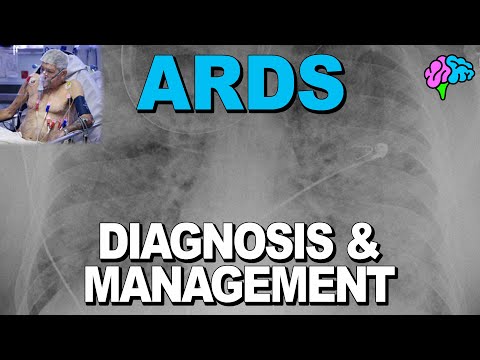 Diagnosis and Management of Acute Respiratory Distress Syndrome (ARDS)