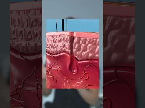 How to remove blackheads 😲