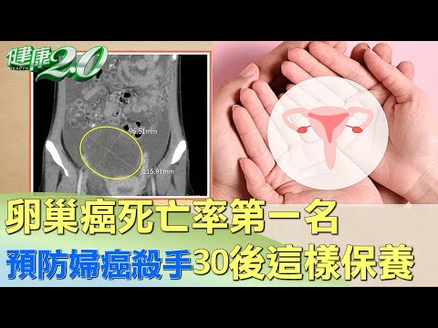 卵巢癌死亡率第一名 預防婦癌殺手30後這樣保養 健康2.0