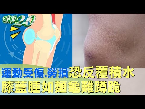 運動受傷.勞損恐反覆積水 膝蓋腫如麵龜難蹲跪 健康2.0 @tvbshealth20
