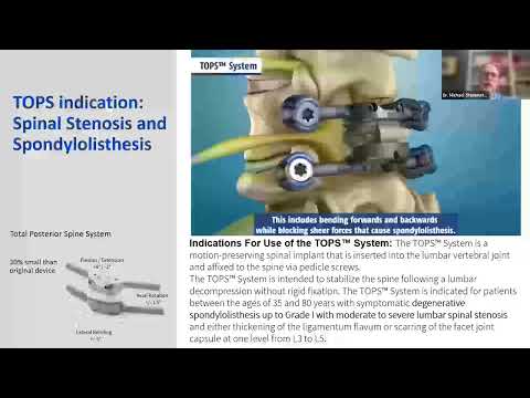 Dr. Michael Steinmetz on the TOPS™ System: A Motion-Preserving Alternative to Spinal Fusion