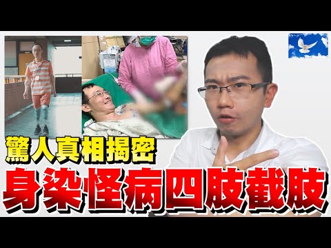 [鋼鐵教授] 爬山染怪病竟截四肢!? 何種病如此可怕? | 蒼藍鴿評評理EP18