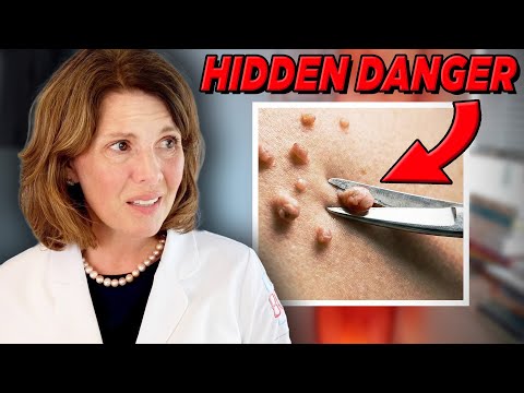 The cure for skin tags will surprise you!