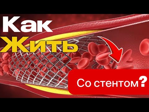 Есть ли жизнь после СТЕНТА | узнай сколько тебе осталось #всеососудах