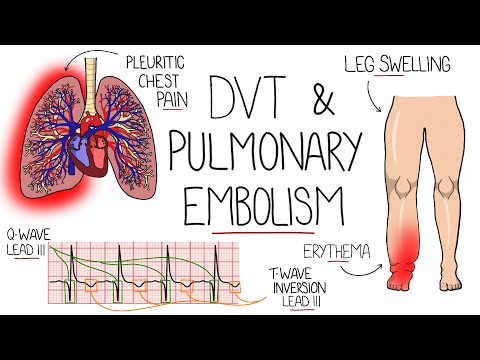 Deep Vein Thrombosis (DVT) & Pulmonary Embolism Explained
