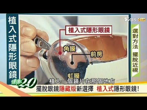 晚上戴角膜塑型片睡覺，白天就能擺脫惱人眼鏡？！健康2.0