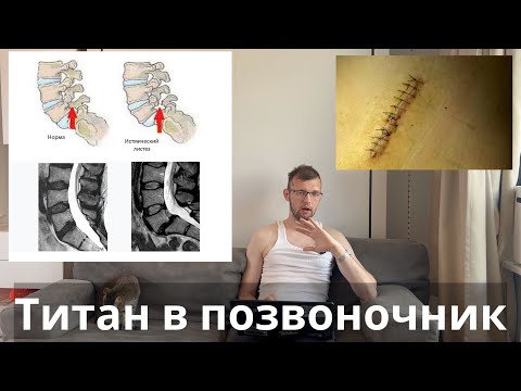 Как я пережил операцию на позвоночнике и поставил себе титановые штифты