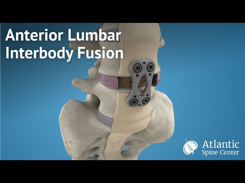 Anterior Lumbar Interbody Fusion (ALIF)