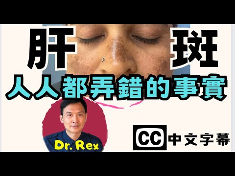 肝斑和肝臟有什麼關係？ 教你有效方法清除。melasma: what is it and how to treat it