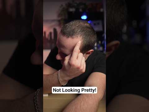 1 Month Hair Transplant Update!