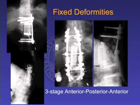 Surgical Approaches: Costotransversectomy for Spinal Reconstruction