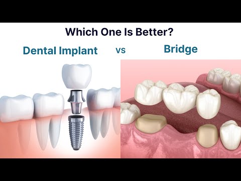 Dental Implant vs Bridge. Which one is better to replace a missing tooth?