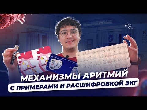 Механизмы аритмий  С примерами и расшифровкой ЭКГ