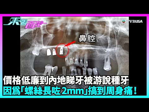 東張西望｜港人選擇內地牙科服務卻忽視安全風險；事主深圳種牙後螺絲險刺穿鼻腔，牙醫院否認手術失誤｜TVBUSA｜民生