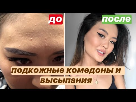 КАК Я ИЗБАВИЛАСЬ ОТ ПРЫЩЕЙ|подкожные прыщи и закрытые комедоны