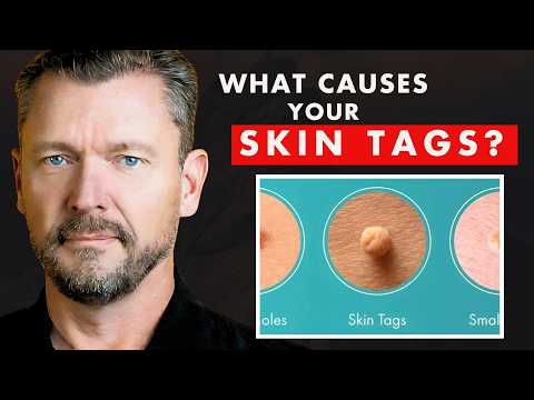 What SKIN TAGS Really Mean  (What Causes Skin Tags?)
