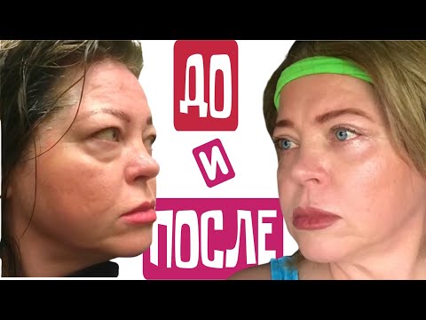 Блефаропластика. Как я это пережила, не понимаю! .#натальяфальконе #сша #usa