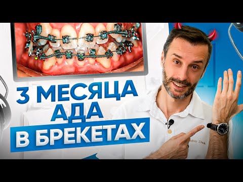 Первые 3 месяца лечения на брекетах — самый сложный период