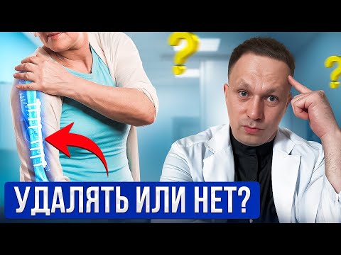 Should plates and screws be removed after a fracture? Metal removal surgery