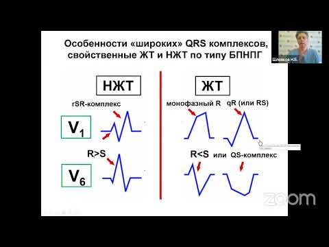 Новые ЭКГ-критерии дифференциальной диагностики тахикардий с широкими комплексами QRS