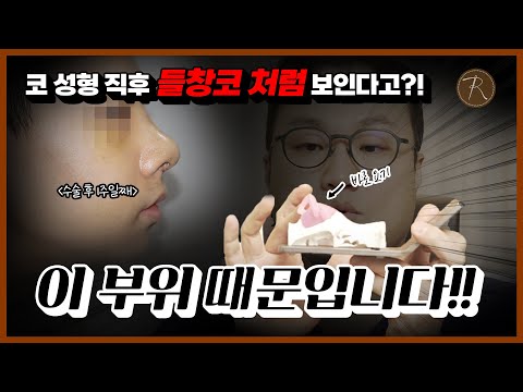 Why does my nose look upturned after rhinoplasty?