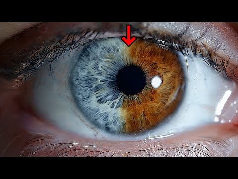 Eye Condition You Might Never See + 20 Rare Body Features