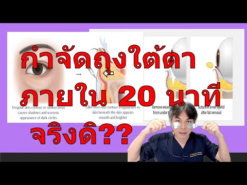 ถุงใต้ตา กำจัดอย่างไรภายใน 20 นาที จริงดิ???   !!!!