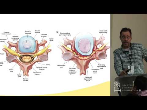 Management of Cervical Stenosis - Charles A. Sansur, MD