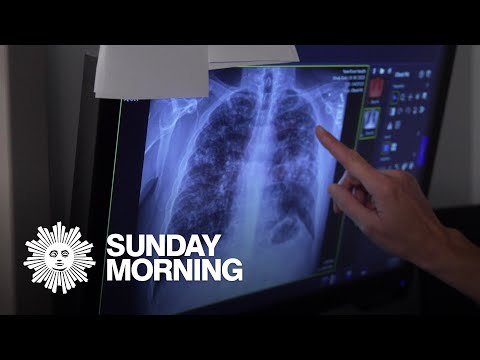 Young coal miners suffering from black lung